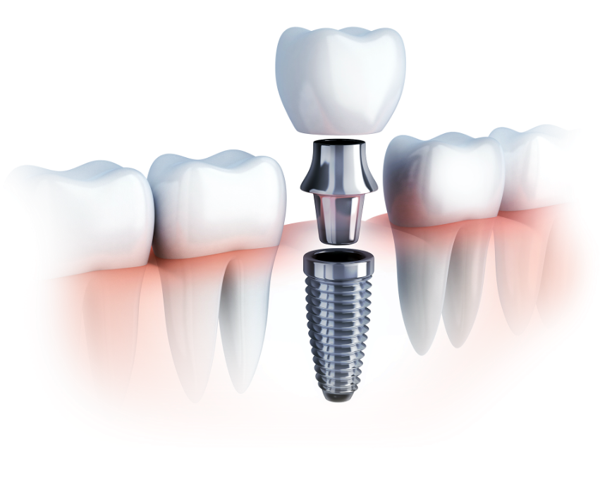 Dental Implants