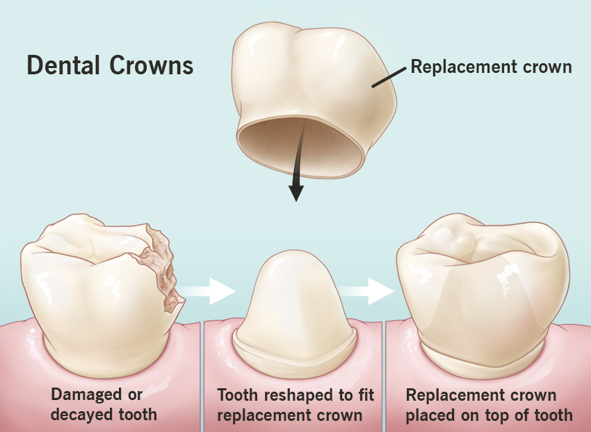 Prosthodntics Crown