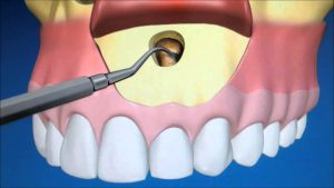 Oral Surgery