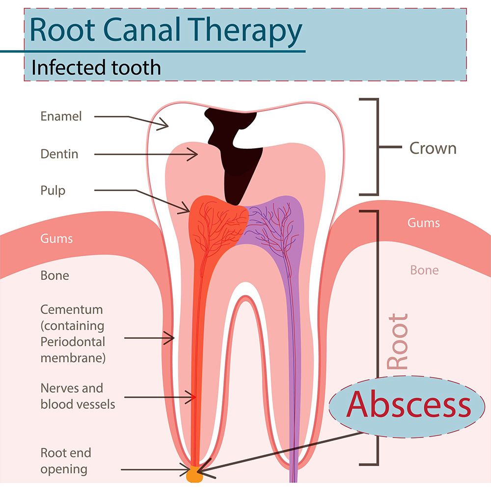 Root Canal Treatment