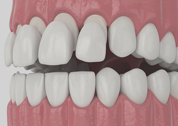 Tooth Colour Filling