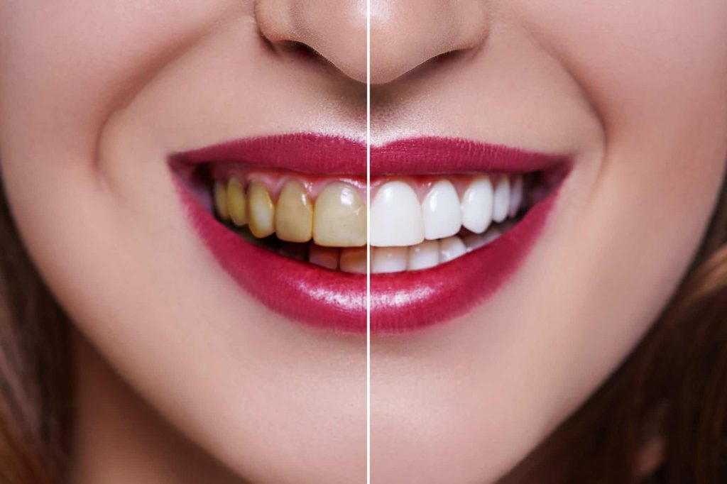 Tooth Colour Filling